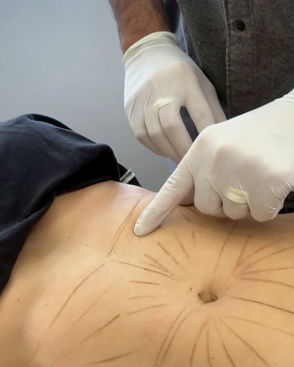 Aplicação injetável de bioestimulador de colágeno com marcações na pele
