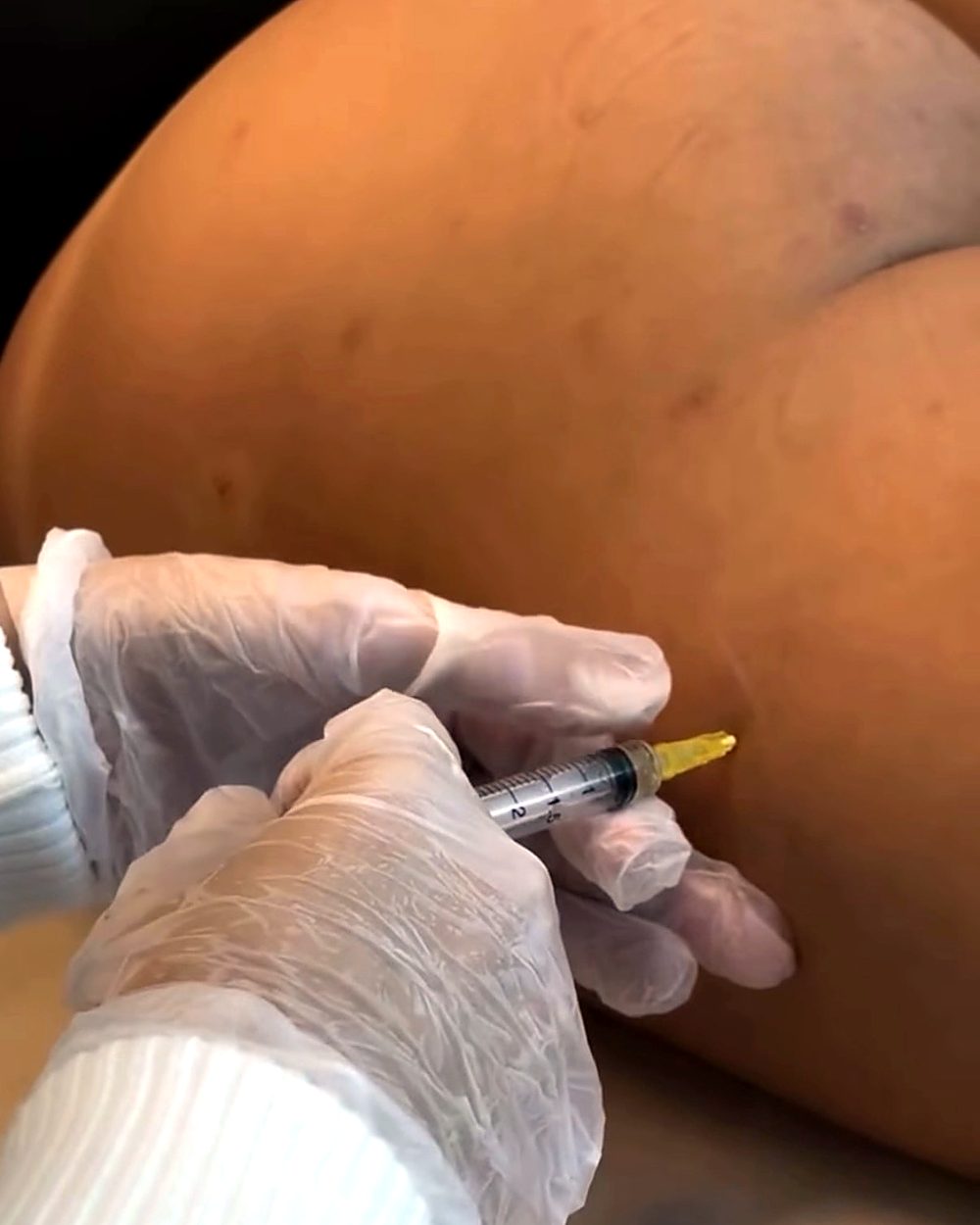 Aplicação de lipo enzimática na região dos culotes