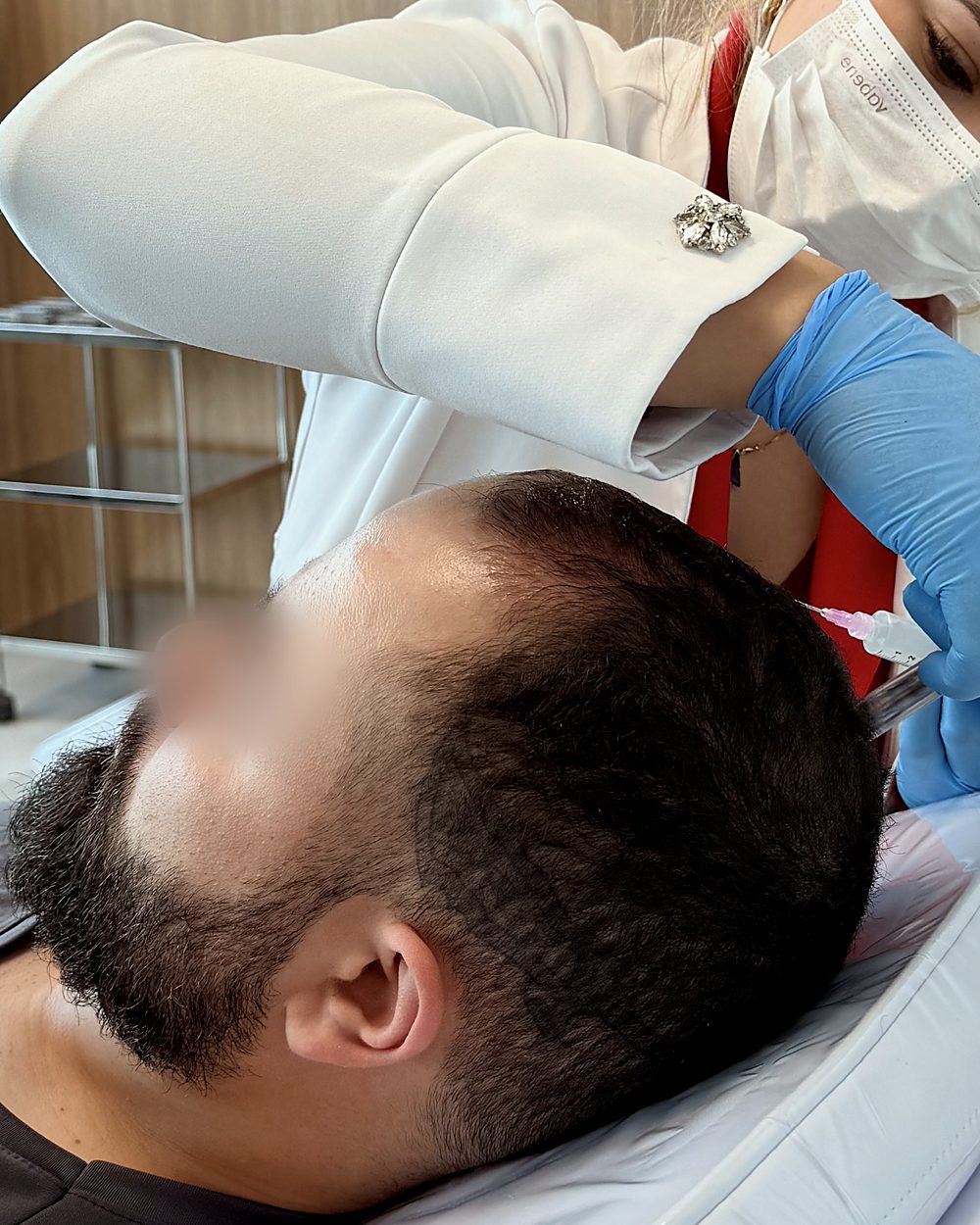 Microagulhamento associado à mesoterapia capilar