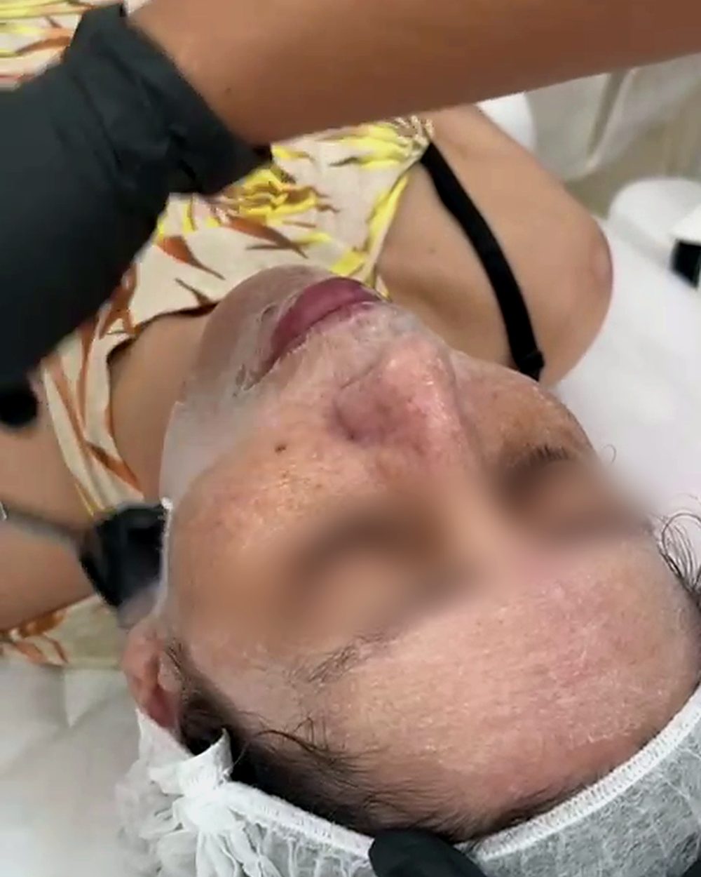 Peeling facial em atendimento