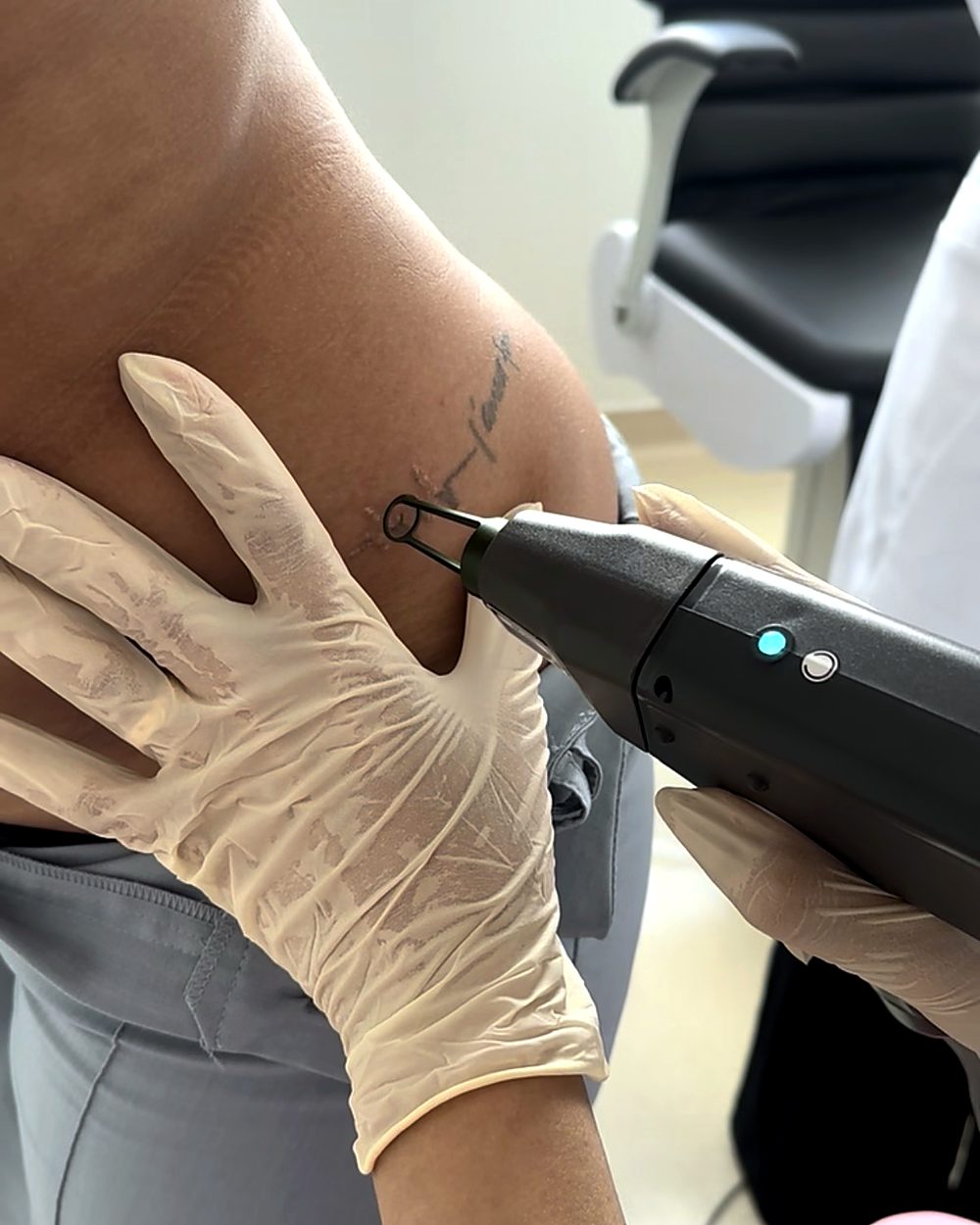 Remoção de tatuagem com equipamento de laser